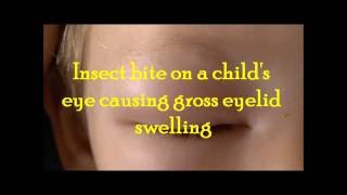 Gross eye swelling on a child following an insect bite and treatment [upl. by Peyton198]