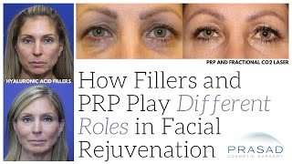 How Fillers and PlateletRich Plasma PRP Play Different Roles in Facial Rejuvenation [upl. by Mccready]