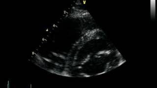 ARVC ARRHYTHMOGENIC RIGHT VENTRICULAR CARDIOMYOPATHY DAVD [upl. by Xet7]