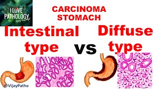 Carcinoma Stomach INTESTINAL VS DIFFUSE GASTRIC CANCER [upl. by Adniled]