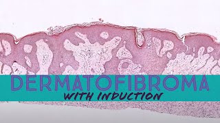 Dermatofibroma with induction phenomenon pathology dermpath dermatology dermatopathology [upl. by Eyde]