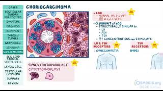 Testicular Tumors  Osmosis [upl. by Lynsey]