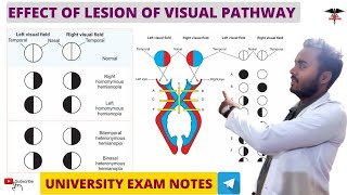 Effect Of Lesion On Visual Pathway  Special Sense Physiology [upl. by Ahsilem671]