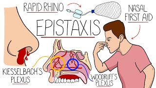 Understanding Epistaxis Nosebleeds Explained [upl. by Ylac]