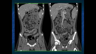 CT Evaluation of Suspected SBO State of the Art 2024  Part 4 [upl. by Inad619]