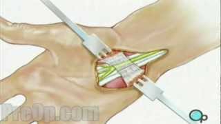 Carpal Tunnel Syndrome Repair Surgery  PreOp® Patient Education Medical HD [upl. by Eisele]