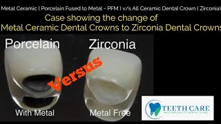 Zirconia  All Ceramic  versus Metal Ceramic Dental Crowns  Best Cosmetic Dentist Kolkata [upl. by Leigh]