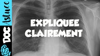 🔴 Dr Astuce  3 ANOMALIES RADIO THORAX EXPLIQUÉES CLAIREMENT  PARTIE 1 [upl. by Nelson]