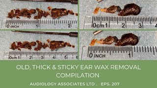 OLD THICK amp STICKY EAR WAX REMOVAL COMPILATION  EP 207 [upl. by Marcelia776]