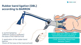 Hemorrhoidal Disease Surgery Explained  Full Lecture Hemorrhoidectomy [upl. by Akcimat]