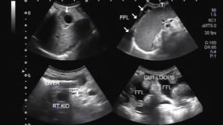 Ultrasound Video showing findings of a typical patient suffering from Hepatic Parenchymal disease [upl. by Whitney]