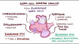 Germ cell ovarian tumors [upl. by Akived]