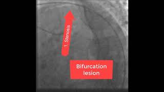 Bifurcation coronary stenting [upl. by Sikata]