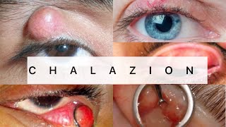 Chalazion  Ophthalmology  EASY MBBS [upl. by Cinom]