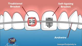 Vincent Team Orthodontics SelfLigating Braces [upl. by Leihcim]