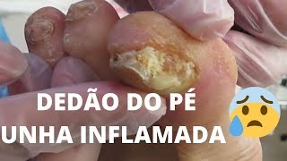 DEDÃO DO PÉ UNHA TOTALMENTE INFLAMADA E COM PUS [upl. by Eenwat]