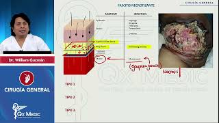 CIRUGÍA GENERAL Complicaciones quirúrgicas Fascitis necrotizante mp4 [upl. by Sarchet]