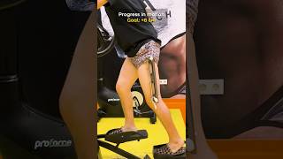 Getting Taller Leg Lengthening Progress at One Month leglengthening [upl. by Shult]