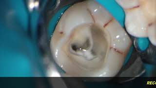 PASSIVE ultrasonic irrigation irrisafe during one visit endodontic treatment [upl. by Ecinuahs529]