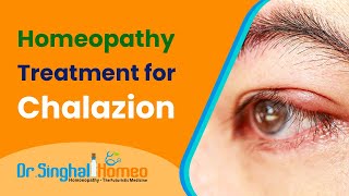 Best Homeopathic Treatment for Chalazion  Dr Singhal Homeo [upl. by Renba571]