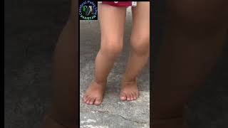 Cerebral Palsy Diplegic with Crouch Gait can only stands with Crouch Posture [upl. by Anelac]