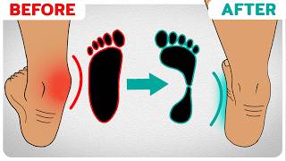 How to Correct Overpronation Fallen Arches [upl. by Ignatius309]