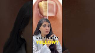 Nail Fungal Infection Treatment  How to get rid of toenail fungus  Nail Fungal infection [upl. by Nino]