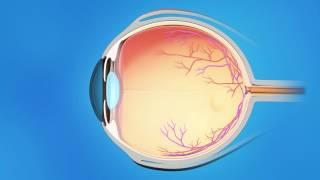 Trabecular Bypass Stent for Glaucoma [upl. by Brag]