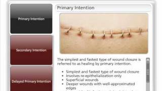 Types of Wound Closure [upl. by Juna]