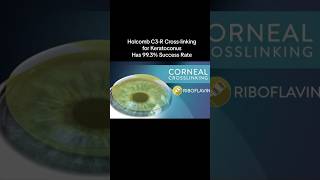 Eye Bulge Keratoconus Treatment with Holcomb C3R Crosslinking shorts keratoconus crosslinking [upl. by Ayeki]