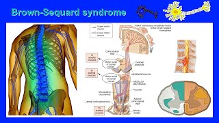 Brown Sequard syndrome [upl. by Homovec]