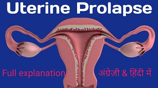 uterine prolapse presentationuterine prolapse symptomsuterine prolapse lecture in Hindiexercise [upl. by Efinnej]