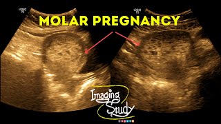 Molar Pregnancy  Hydatidiform Mole  Gestational Trophoblastic Disease  Ultrasound  Case 38 [upl. by Anelyak]