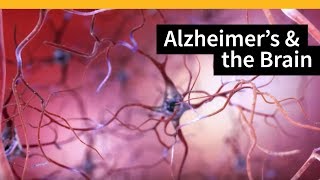 How Alzheimers Changes the Brain [upl. by Laurene994]