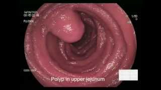 Jejunal polyp [upl. by Cheung536]