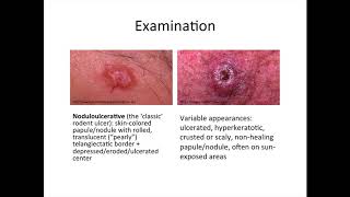 Dermatology  basal cell carcinoma and squamous cell carcinoma [upl. by Hgielrebmik748]