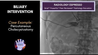 BILIARY INTERVENTION Case Example  PERCUTANEOUS CHOLECYSTOSTOMY [upl. by Neelyar]