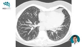 Micronodulos Pulmonares [upl. by Pry]