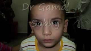 الحول الوحشي المتقطع  Intermittent Exotropia [upl. by Crin]