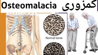 Osteomalacia Causes symptoms Diagnose Treatment  Medicine for Osteomalacia in HindiUrdu [upl. by Whale705]