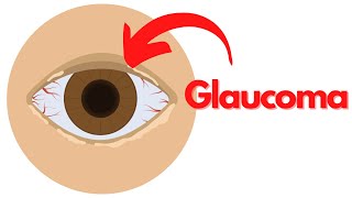 What is GLAUCOMA Symptoms Causes Treatment Prevention [upl. by Fe649]