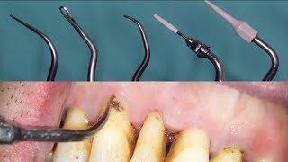 Scaling and root planing also known as conventional periodontal therapy [upl. by Ximenez71]