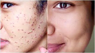 WartsDPNs Removal Diary What to Expect When Removing Skin Tags [upl. by Eiramanitsirhc269]