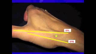 Thumb CarpalMetacarpal CMC Joint injection [upl. by Eecram]