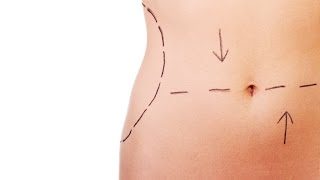 Tummy Tuck vs Liposuction  Plastic Surgery [upl. by Neelac588]