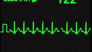 Sinus Tachycardia  ECG Simulator  Arrhythmia Simulator [upl. by Loar46]