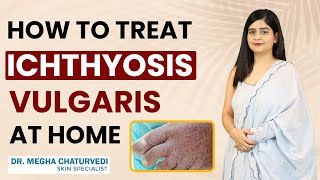 How to Treat Ichthyosis Vulgaris at Home  Home Remedies for Ichthyosis Vulgaris Fish Skin [upl. by Ohaus518]