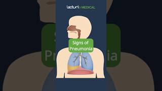 Recognizing the Signs of Pneumonia 🩺 MedicalEducation USMLE [upl. by Binnings]