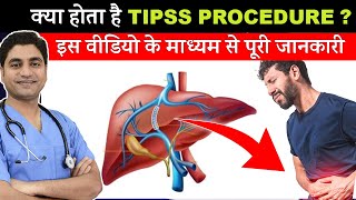 What is Transjugular Intrahepatic Portosystemic Shunt TIPS Procedure amp Used Cases [upl. by Aldric]