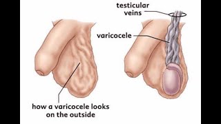 Why Testicular varicocele would occur mostly on the left testis veins or left pampiniform plexus [upl. by Nonnarb]